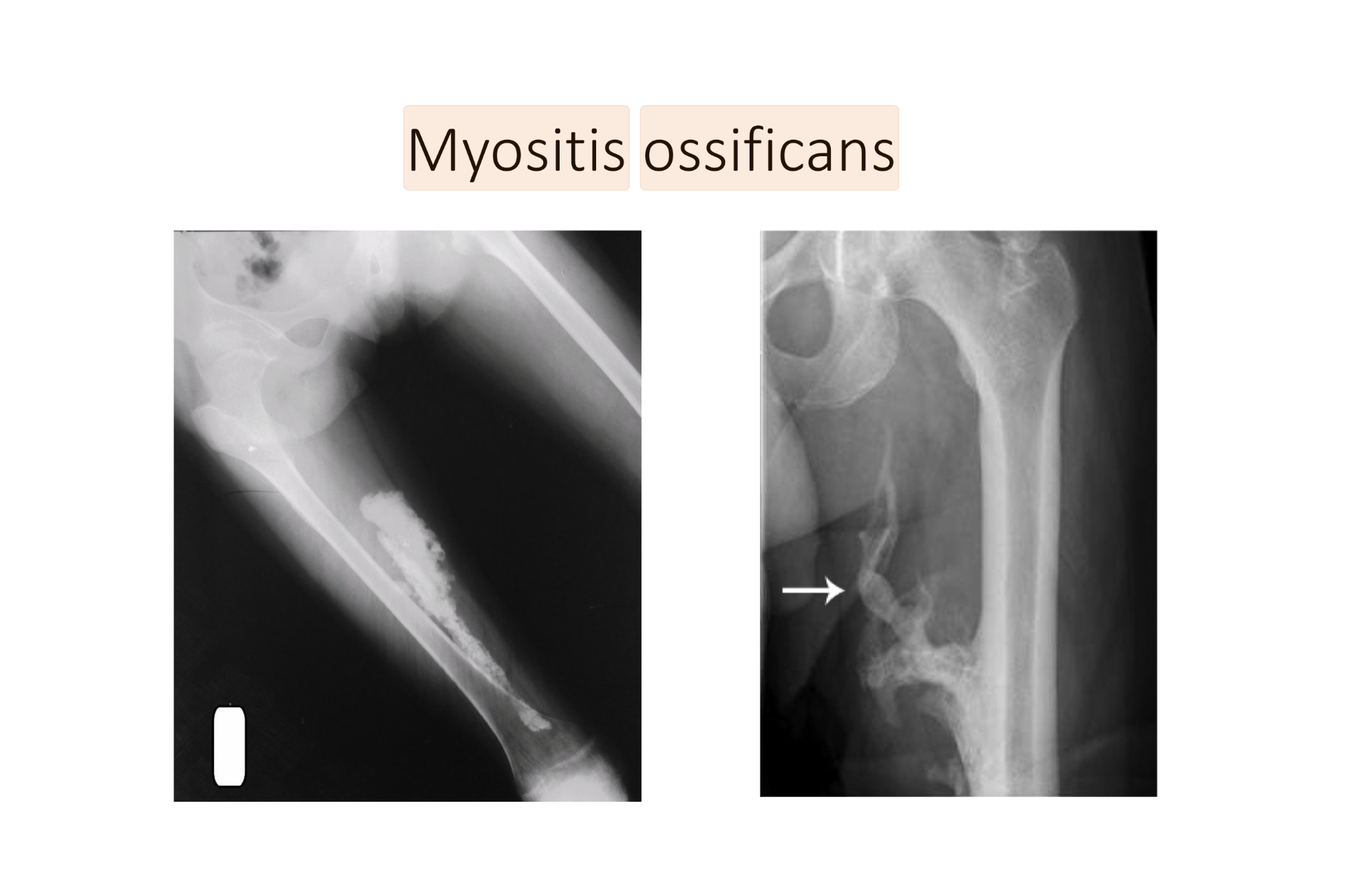 <ul><li><p>Connective Tissue</p></li><li><p>Eposides of Fever or Soft Tissue Inflammation </p></li><li><p>Harden</p></li><li><p>How:</p><ul><li><p>Often in Early Childhood or after trauma</p></li><li><p>Maybe from massage or STM TOO EARLY in rehab </p></li><li><p>Lack of RICE after injury </p></li></ul></li><li><p>Muscles:</p><ul><li><p>Quads</p></li><li><p>Brachialis</p></li><li><p>Deltoid</p></li></ul></li><li><p>Tx:</p><ul><li><p>Ice in fully stretched positions</p></li><li><p>STOP MASSAGING AND USING HEAT </p></li></ul></li></ul><p></p>