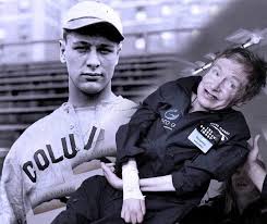 <p>-Motor neurons in CNS &amp; PNS are replaced by scar tissue over time (plaques)</p><p>-AKA Lou Gehrig’s disease</p><p>-onset ~57 y.o.</p><p>-death in 2- 5 years after onset</p><p>Symptoms</p><ul><li><p>muscle weakness/atrophy<strong> progresses distally to proximally</strong></p><ul><li><p>most common first symptoms are <em>weakness in small </em><strong><em>hand muscles</em> </strong>or asymmetrical foot drop</p></li></ul></li><li><p>Muscle cramping at night- usually in calves</p></li><li><p>Corticospinal tract involvement symptoms: spasticity &amp; hyperactive deep tendon reflexes</p><p><span data-name="high_voltage" data-type="emoji">⚡</span>️spinal &amp; spasticity</p></li><li><p>Corticobulbar tract involvement</p><ul><li><p>Dysarthria (slowed/slurred speech)</p></li><li><p>Dysphagia (difficulty swallowing)</p></li><li><p><span data-name="high_voltage" data-type="emoji">⚡</span>️difficult to talk/swallow with a bulb in your mouth</p></li></ul></li><li><p>May eventually have difficulty breathing, requiring respiratory therapist to be on team</p></li><li><p>Sensation, vision, hearing, bowel/bladder usually NOT affected</p></li></ul><p>Stages</p><ul><li><p>Stages I-III</p><ul><li><p>can walk, but growing weakness (some → moderate → severe)</p></li></ul></li><li><p>Stage IV</p><ul><li><p>requires W/C (d/t extreme weakness in LEs)</p></li><li><p>require some assistance with ADLs</p></li></ul></li><li><p>Stage V</p><ul><li><p>Dependent with ADLs (d/t extreme weakness in arms and legs)</p></li></ul></li><li><p>Stage VI</p><ul><li><p>unable to get out of bed</p></li></ul></li></ul><p>Medications- slightly slow disease progression/reduce negative impacts on functioning but have side effects</p><ul><li><p>Riluzole/Rilutek- dizziness, fatigue, GI issues, liver issues</p></li><li><p>Edaravone (Radicava)- swelling, SOB</p></li></ul><p>Interventions:</p><ul><li><p>because it is progressive/degenerates a large part of functional skills, CAREGIVER education is really important for issues</p></li><li><p>early stage: try to keep some muscle, just dont overexert</p></li><li><p>middle stage: muscle loss will happen, better for ROM</p></li><li><p>late stage: ulcer prevention</p></li><li><p>W/C recs: often start with high backed, reclining, light weight, small turning radius, with head/trunk/extremity support then progress to power W/C with adaptable controls</p></li><li><p>Use voice operated/hands-free tech</p></li><li><p>Can extend ability to drive a car by using hand controls and adding W/C lift</p></li></ul><p></p>