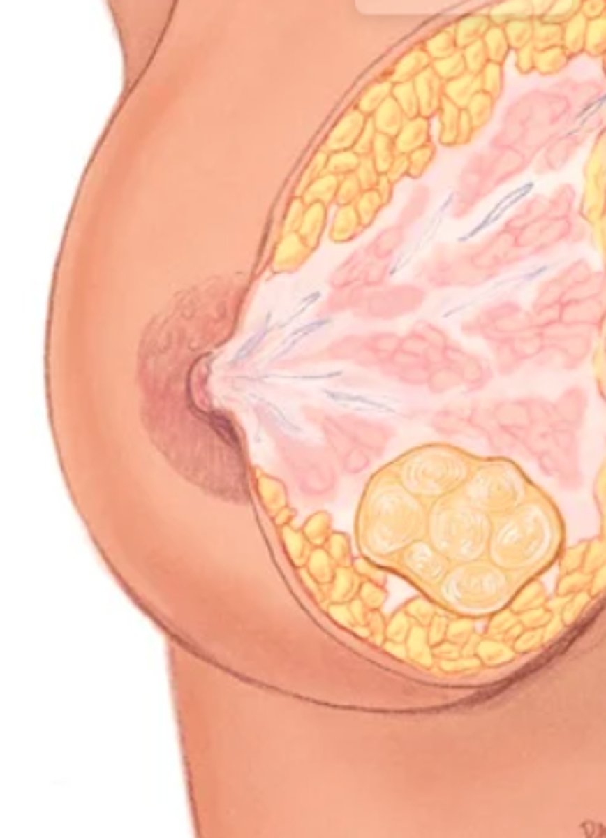 <p>Benign mass, most commonly self-detected in late adolescence and early adulthood.</p><p>-Solitary nontender mass that is solid, firm, rubbery, and elastic.</p><p>- Round, oval, or lobulated; 1 to 5 cm; clear margins.</p><p>- Freely movable, slippery; fingers slide it easily through tissue.</p><p>- Usually no axillary lymphadenopathy but frequently painful.</p><p>- May resolve spontaneously in those younger than 20 years.</p><p>-Diagnose by palpation, ultrasound, and needle biopsy.</p><p>-Because of risk of deformity of surgery to a growing breast, excisional surgery is reserved for masses &gt;5 cm; for continuously enlarging, well-circumscribed, multiple masses; or with suspicious ultrasound findings.</p>