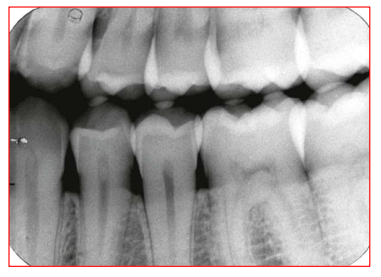 <ul><li><p>Film appears to have overlapping at the contact areas between teeth. </p><ul><li><p>Reason: Incorrect HORIZONTAL angulation; central ray was not directed through interproximal spaces</p></li></ul></li><li><p>Fix: Angle XCP more distally or mesially depending on direction of overlap</p></li></ul><p></p>