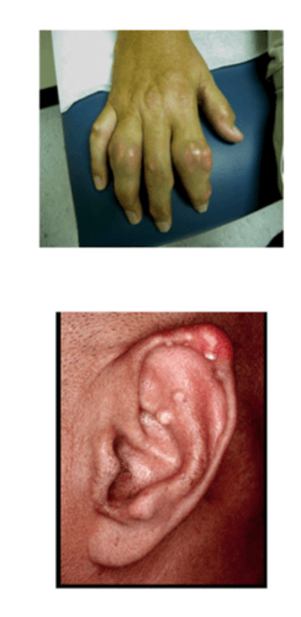 <p><strong>Podagra and episodic oligoarticular arthritis</strong></p><p>• Can awaken pts in the night with dramatic pain, redness, swelling, &amp; warmth</p><p><strong>Tophi form – firm, irregular subcutaneous deposits of urate crystals</strong></p><p>• Found along:</p><p>• <strong>Tendinous</strong> tissues</p><p>• Extensor surfaces of joints &amp; tendons</p><p>• Outer helix of the ear</p><p><strong>Erosive arthritis:</strong> can develop w repeated attacks to <strong><span style="text-decoration:underline">same</span></strong> joint</p>