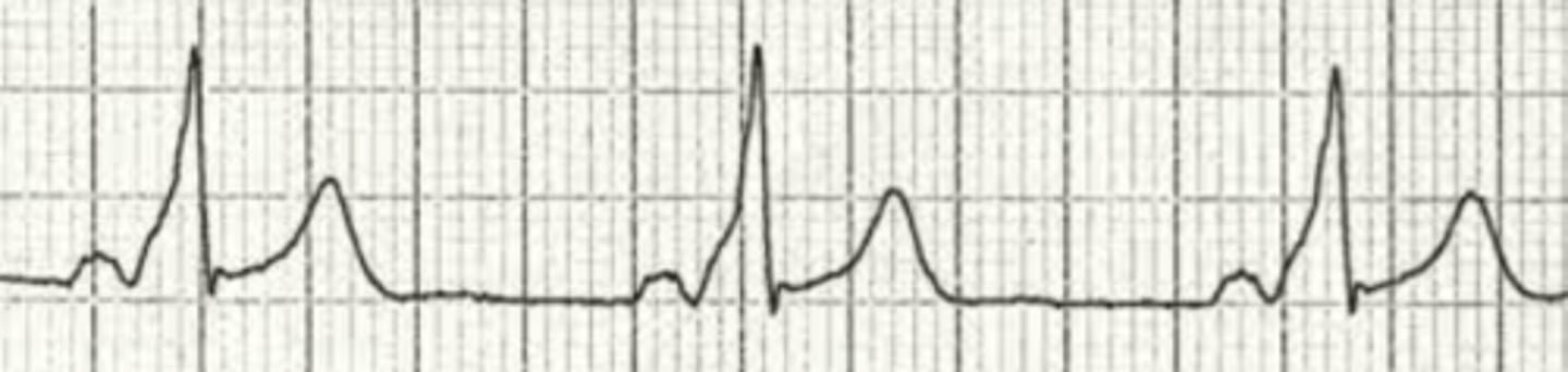 <p>What is the rhythm</p>