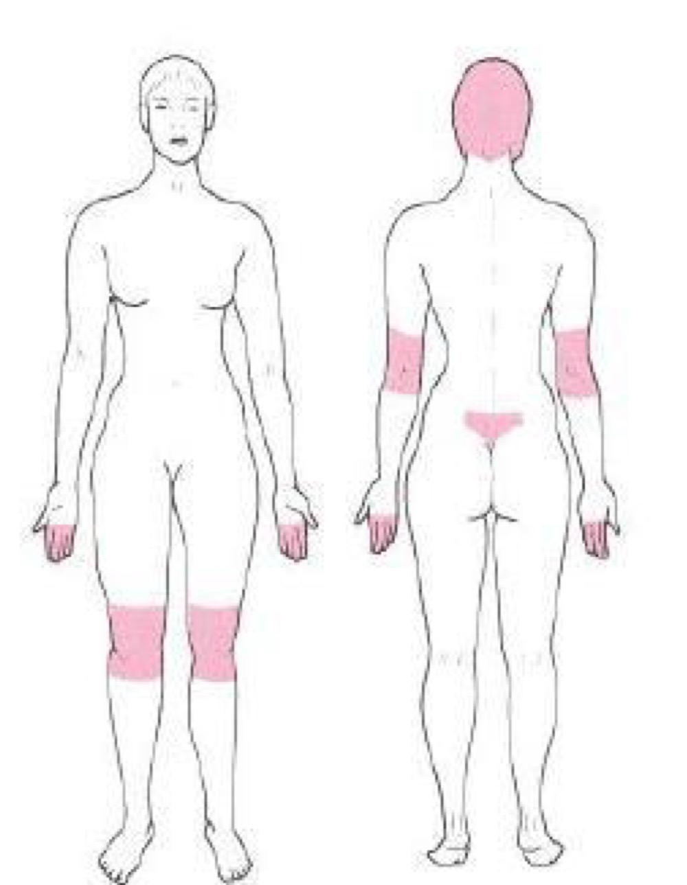 <p>what distribution of skin lesion is this </p>