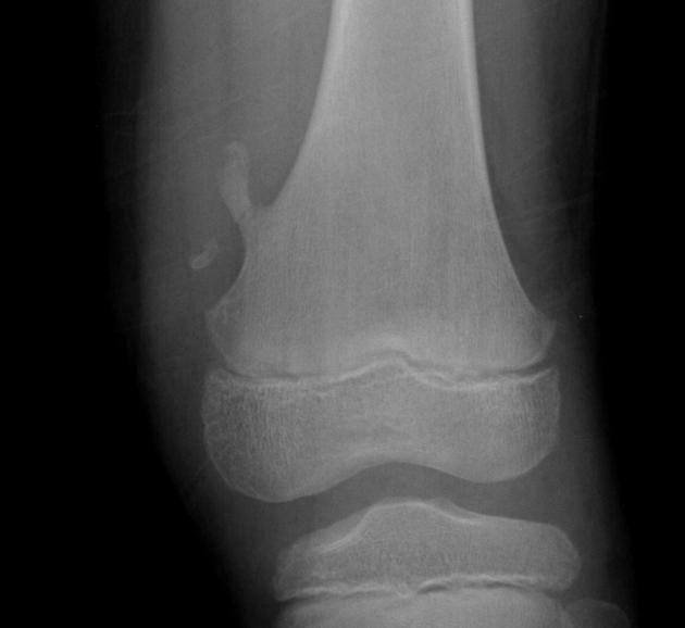 <p>The most common benign bone tumor - arises from the growth zone between the epiphysis and diaphysis of long bones (Metaphysis). Most commonly involves the lower femur or upper tibia and is capped by growing cartilage. Many time it is asymptomatic unless the affected long bone is traumatized which results in a pathologic fx. of the diseased bone.</p>