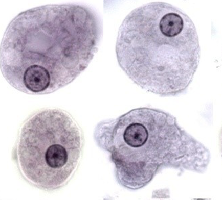 <p>Name: Entamoeba histolytica</p><p class="p1">Stage: trophozoite</p><p class="p1">*Endosome centered</p><p class="p1">*<span> </span>Thin, smooth ring around nucleus</p>