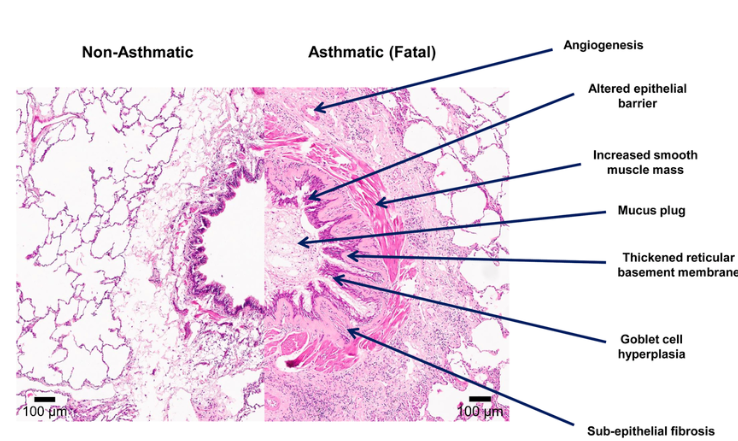 <p><span>Changes occur in airways following:</span></p>