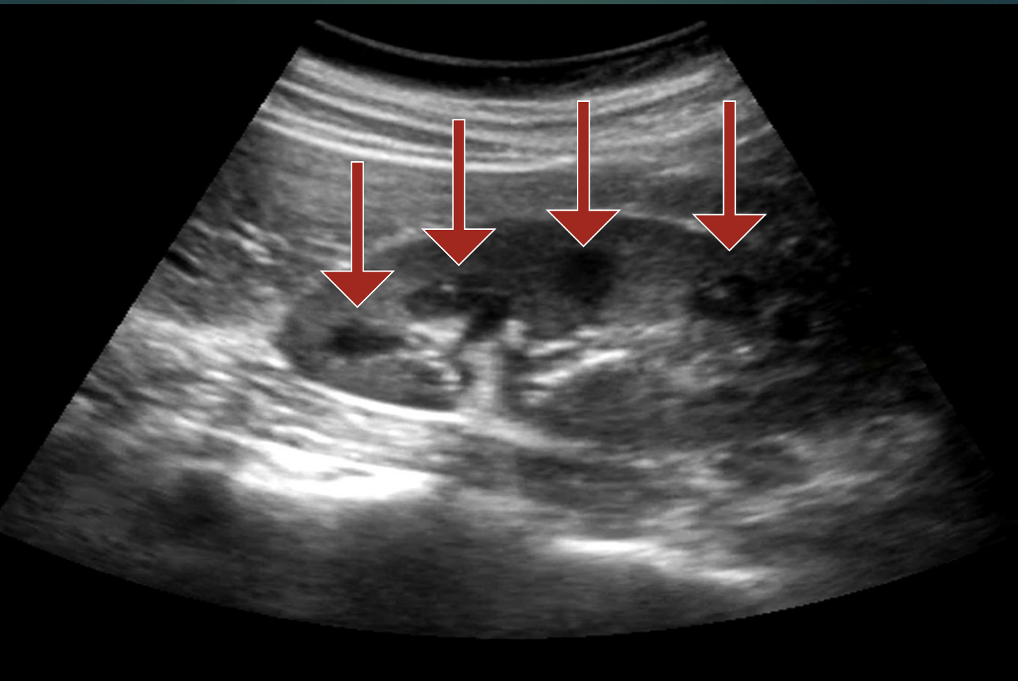 <p>Cone-shaped renal pyramids. </p>