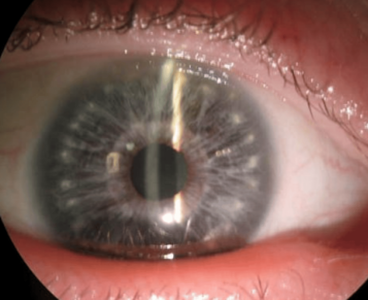 <p>grey brown spots on the iris which are focal areas of stromal hyperplasia. Are more common in light irises and have an association with Down's syndrome.</p>