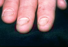 <p>Spoon-shaped nails that may be seen with trauma to cuticles or nail folds or in iron deficiency anemia, or endocrine or cardiac disease</p><p><span style="font-family: Helvetica; font-size: 10px;"><strong>iron-deficiency anemia</strong></span></p>