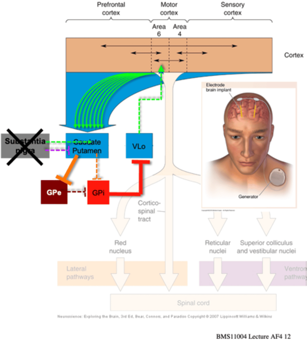 <p>Reduced dopaminergic input from substantial nigra to striatum leads to both ...?</p>