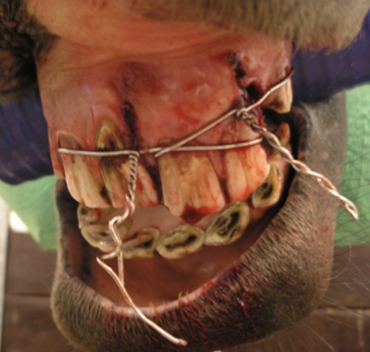 <p>Hvordan vil du behandle denne hest, som har fået fixeret en fraktur af den rostrale maxil?</p><p>- 21 dages oral sulfa-TMP, cerclage fjernes efter 6 uger.</p><p>- Sondefodring indtil frakturen er næsten helet (ca. 4 uger).</p><p>- Fem dages behandling med penicillin og finadyne, cerclage fjernes efter ca. 6 uger.</p><p>- Fem dages behandling med gentamycin og finadyne, cerclage fjernes efter ca. 6 uger.</p>