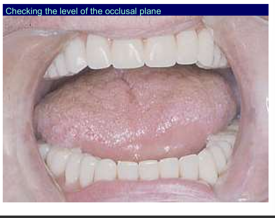 <p>the tongue can sit nicely on the occlusal surface of the lower denture is what your are trying to achieve</p>