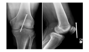 <p>1 x-ray done straight on ( PA or AP) → Nail seems deep </p><p>1 x-ray 90 degree from that projection for true lateral → Nail adjacent to knee after true lateral </p>