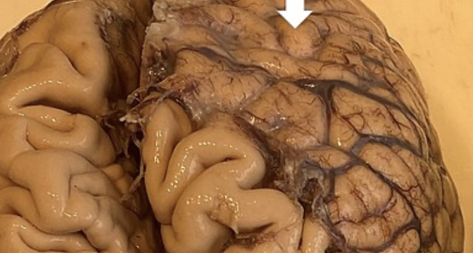 <p>Web-like layer of the meninges filled with fluid that cushions the brain</p>