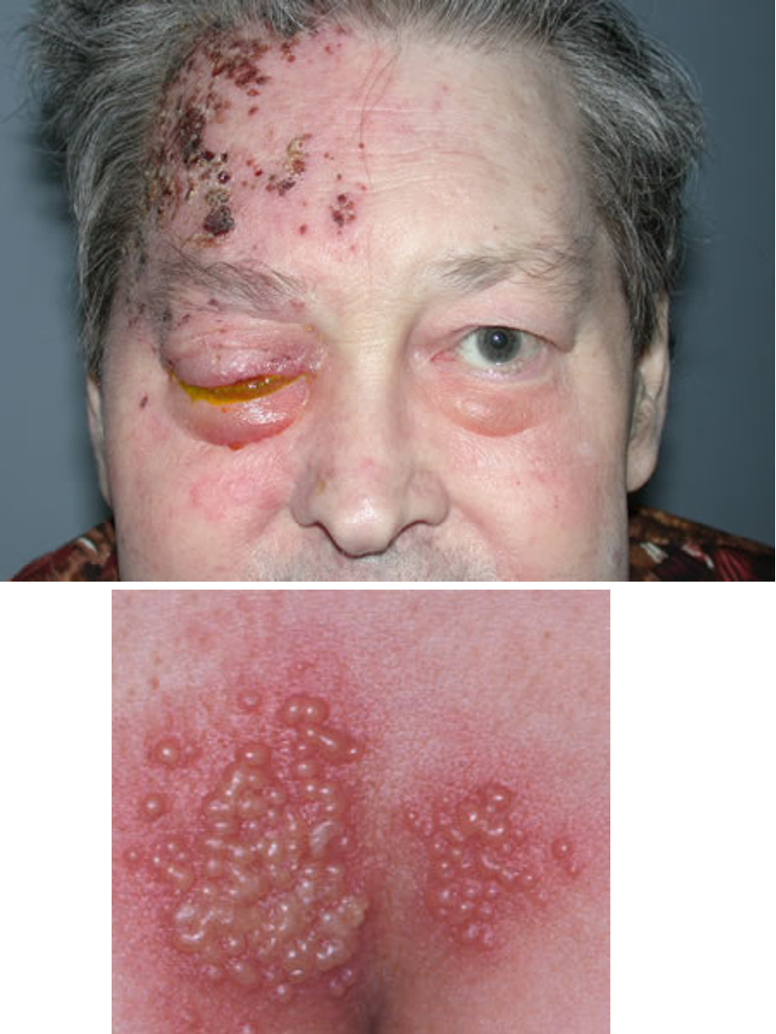 <p>CN V (trigeminal ophthalmic branch), extremely painful, unilateral, <strong>hutchinson sign (lesions on nose)</strong></p>