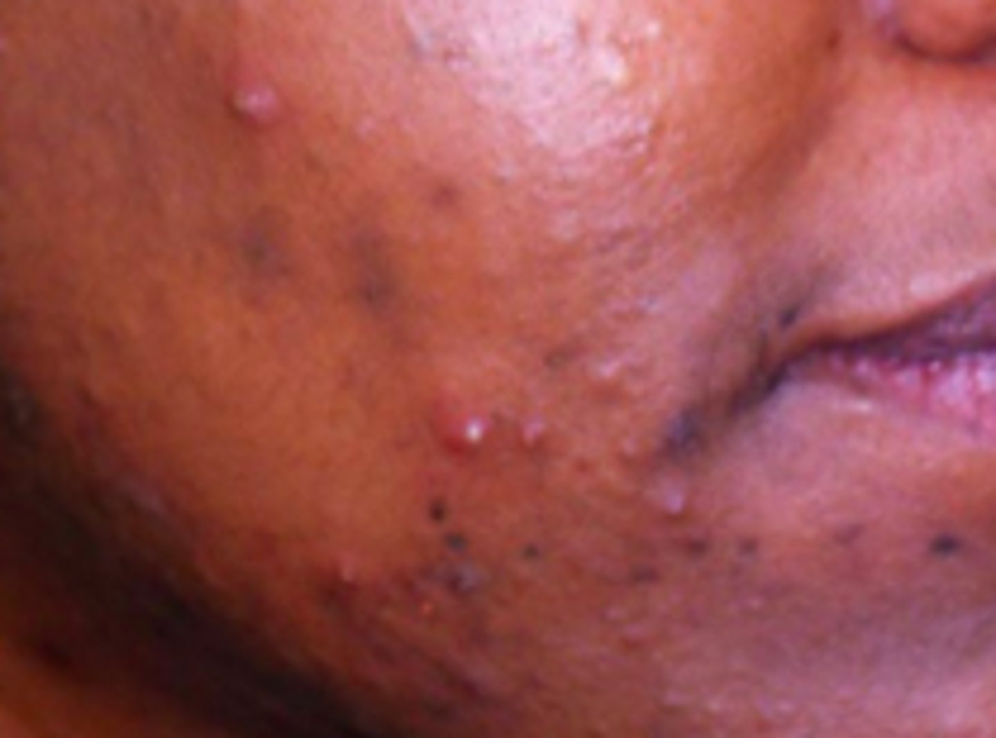 <p>Acneiform Disorders:</p><p>inflamed, relatively superficial papules and pustules, typically &lt;5 mm in diameter</p>