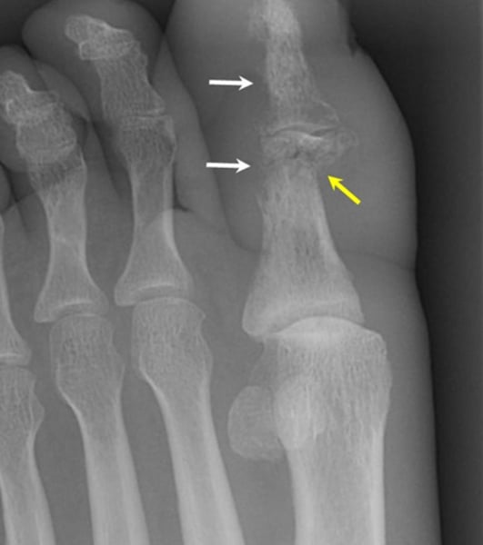 <p>What pathology is seen here?</p>