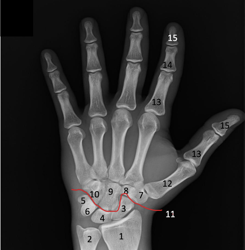 <p>Identify the Scaphoid, lunate, triquetrium and Midcarpal joint in the x-ray.</p>