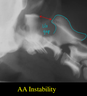 <p>Atlantoaxial Instability</p>