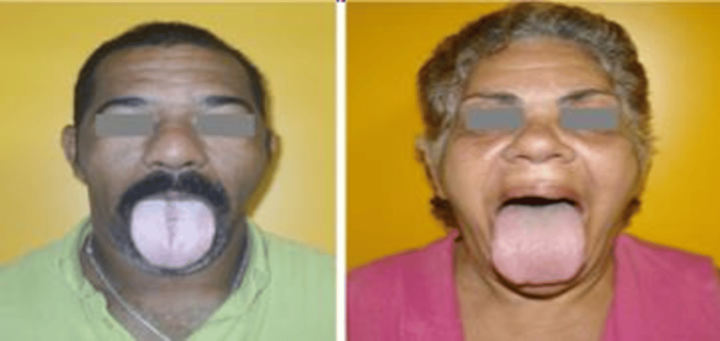 <p>Clinical features of this disorder include:</p><p>•Coarse facial features</p><p>•Hypertrophy of soft palate tissues</p><p>•Mandibular prognathism</p><p>•Anterior open bite (Apertognathia)</p><p>•Diastema formation</p><p>•Macroglossia</p>