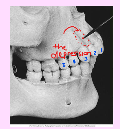 <p>Lateral (canine) fossa </p><ul><li><p>smooth, depression of the maxilla located just inferior and medial to the infraorbital foramen between the canine and lateral incisors </p></li><li><p>Radiography: <strong>radiolucent</strong> area between the max canine and max lateral incisors </p></li></ul><p></p>