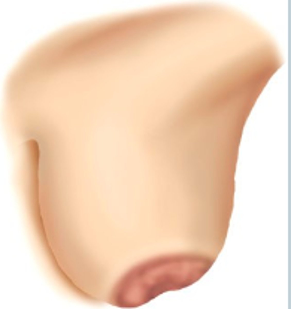 <p>Nipple pulled inward—possible malignancy.</p>