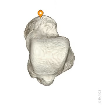 <p>Rounded, convex, distal articular surface of the Talus that fits into the hollow of the Navicular</p>