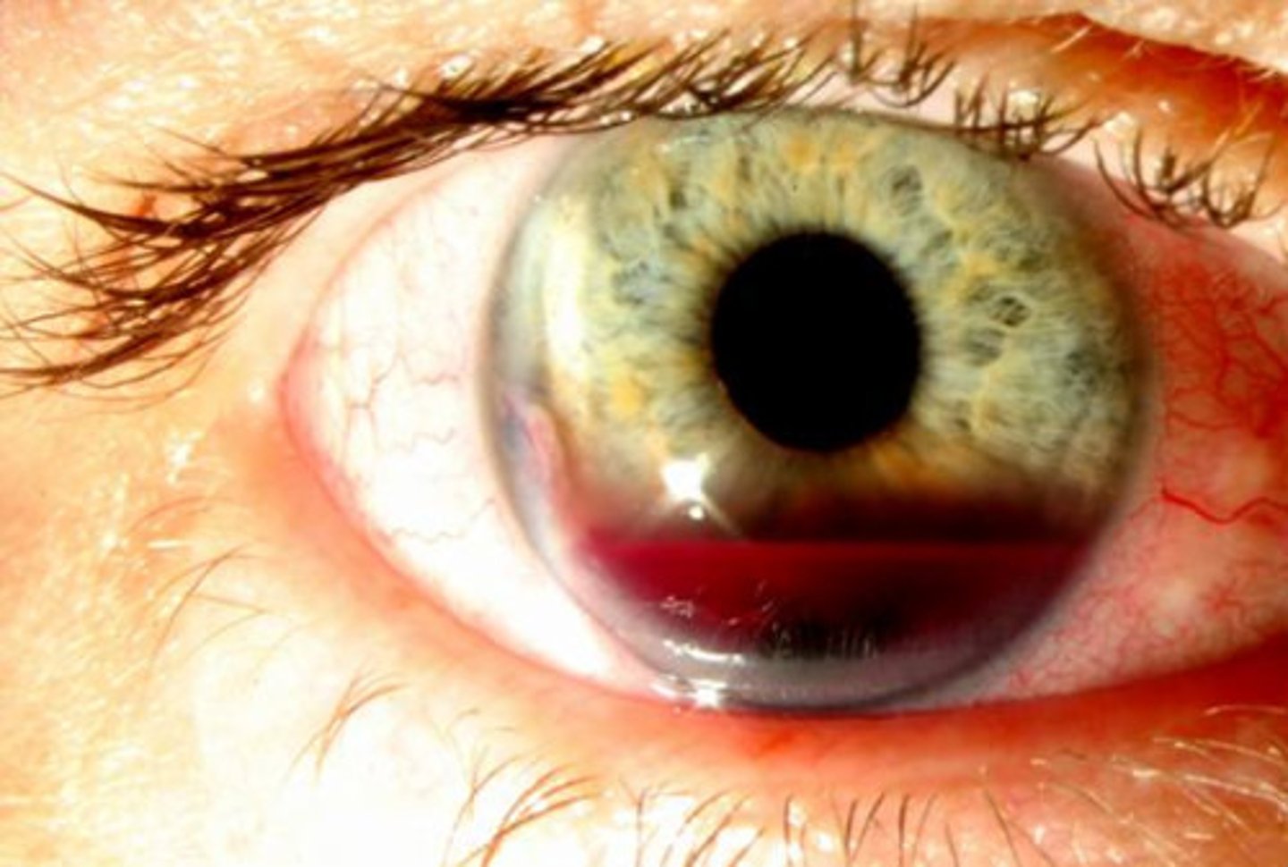 <p>C. Hyphema</p><p>* A subconjunctival hemorrhage will only involve the white of the eye, not the center, and will typically have no pain associated with it</p><p>* A hyphema will only affect the center of the eye, behind the cornea, and will usually have pain and additional symptoms associated with it</p>