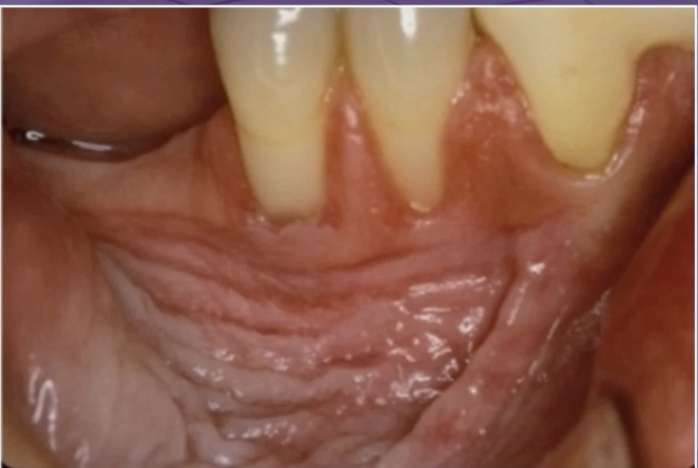 <p>what is the best management </p><p>change toothpaste </p><p>surgical removal </p><p>biopsy if there is a focal area that looks different </p><p>follow up because of its high risk for cancer </p>