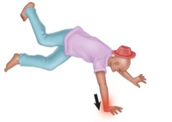 <p>What kind of fracture would this lead to?</p>