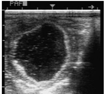 <p>What is this in the ovary and what is it caused by? (2)</p>