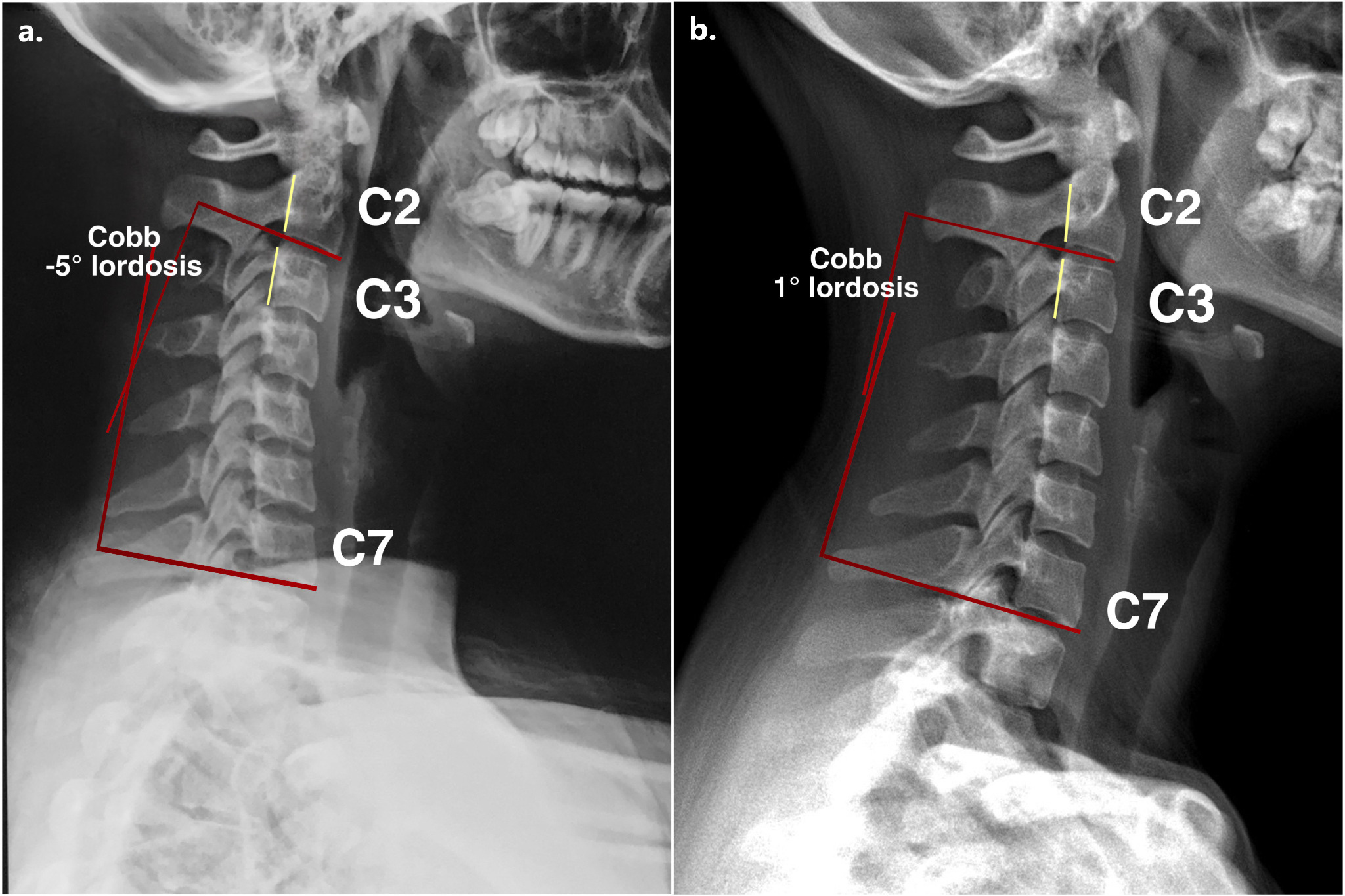 <p>The cervical curvature is located in the neck region of the vertebral column, consisting of the first seven vertebrae (C1-C7) that curve anteriorly. </p>
