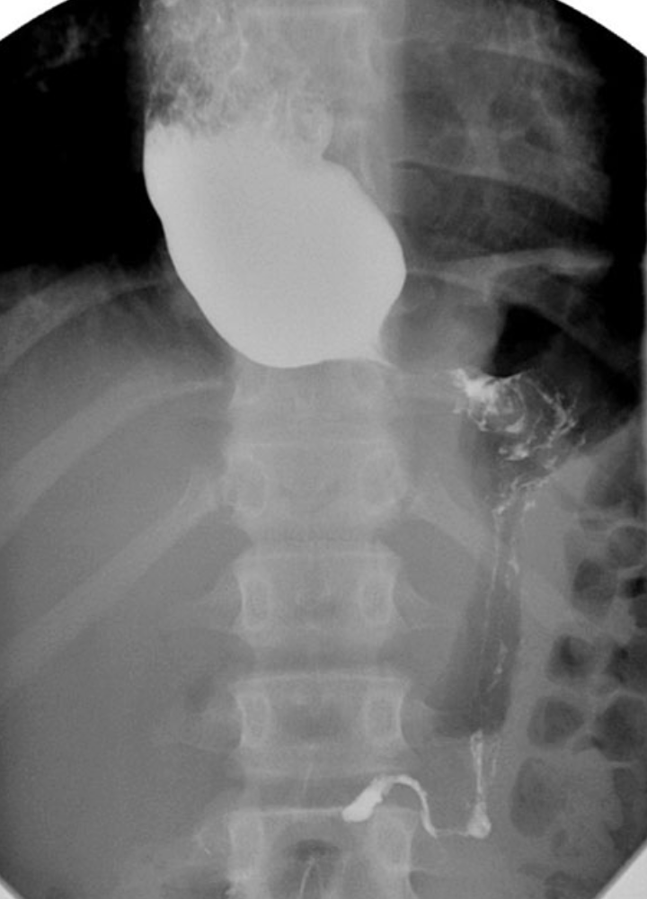 <p>RA of achlasia </p>