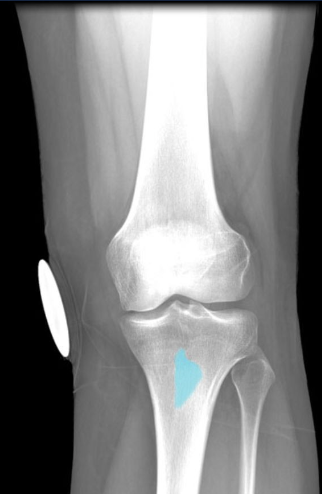 Provides attachment for quadriceps
femoris muscles, via patellar ligament
