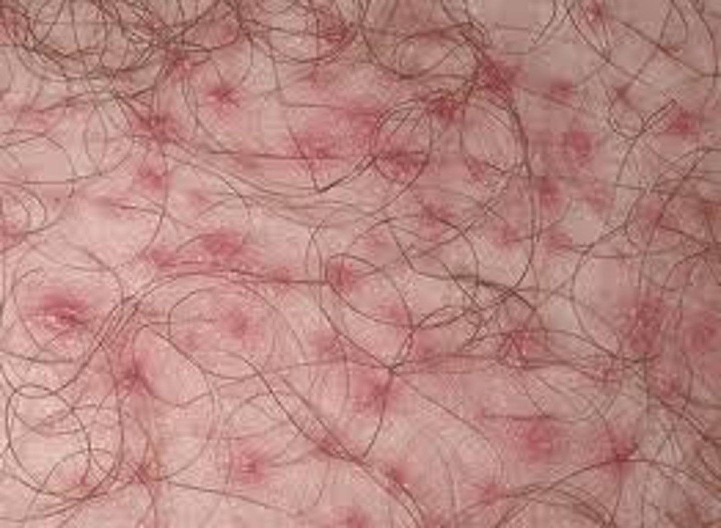 <p>diagnose this image:</p><p>Purulent material in the epidermis→ presents as erythematous papules and pustules surround hair, or in hair bearing area (can occur from G+ organisms and pseduomas in a hot tub)</p>