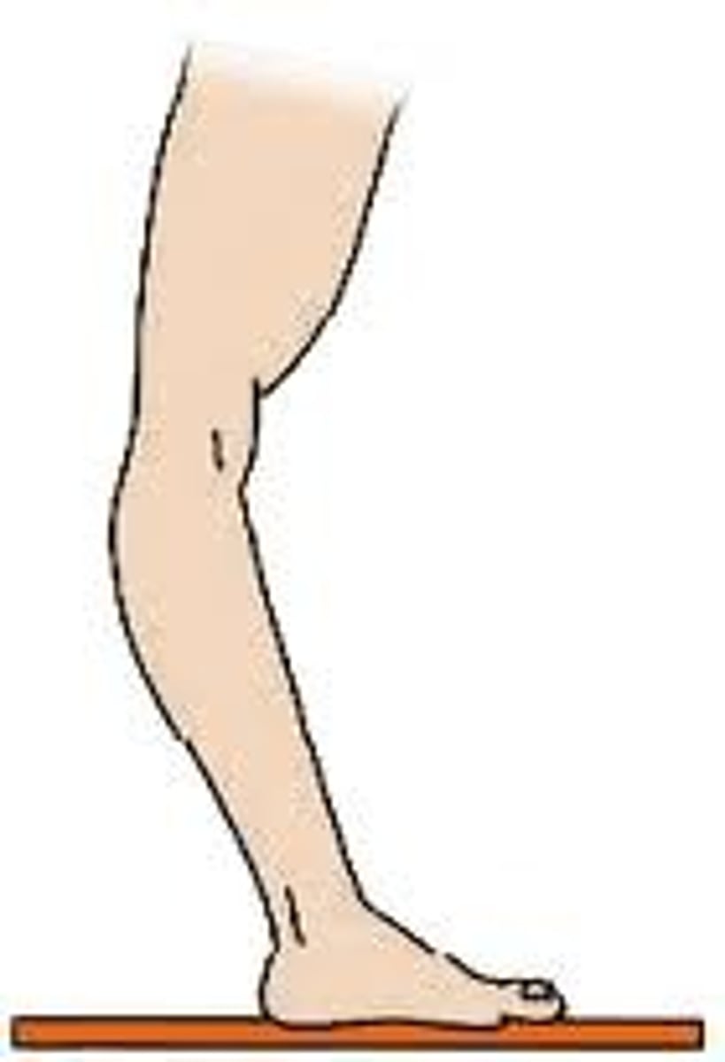 <p>Hyperextension</p>