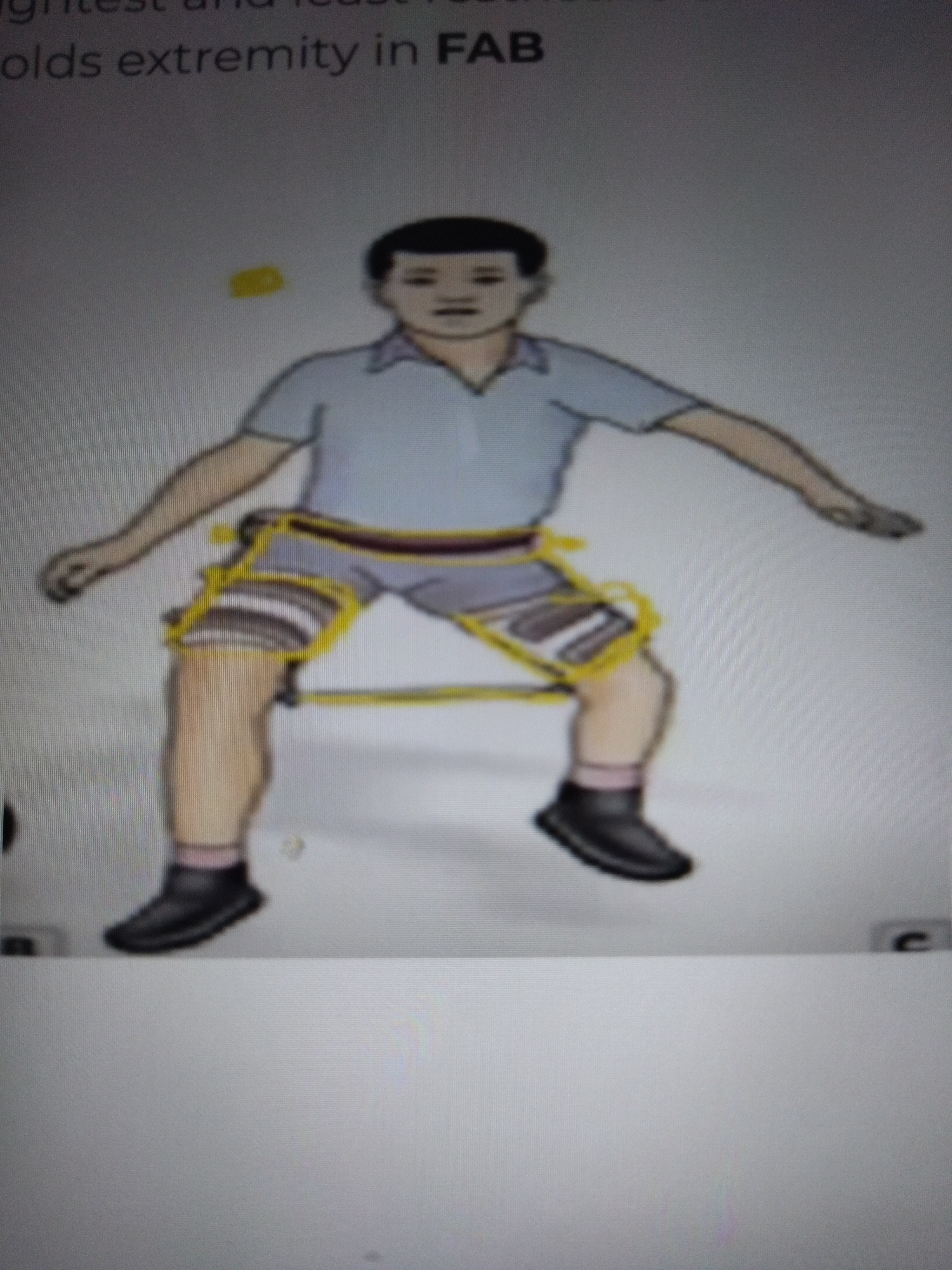 * Has pelvic band, 2 thigh cuffs, 2 thigh joints
* Connected by telescoping rod, adjustable to lengthen/shortened position.
* Lightest and least restrictive out of the three
* Holds extremity in FAb