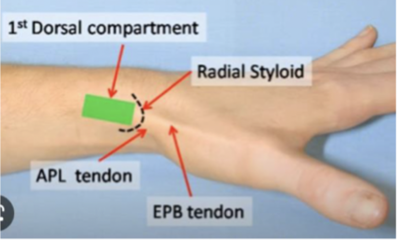 <p>Inflammation of the 1st dorsal compartment (extensor pollicis brevis and abductor pollicis longus at the base of the thumb) due to overuse of the wrist</p>