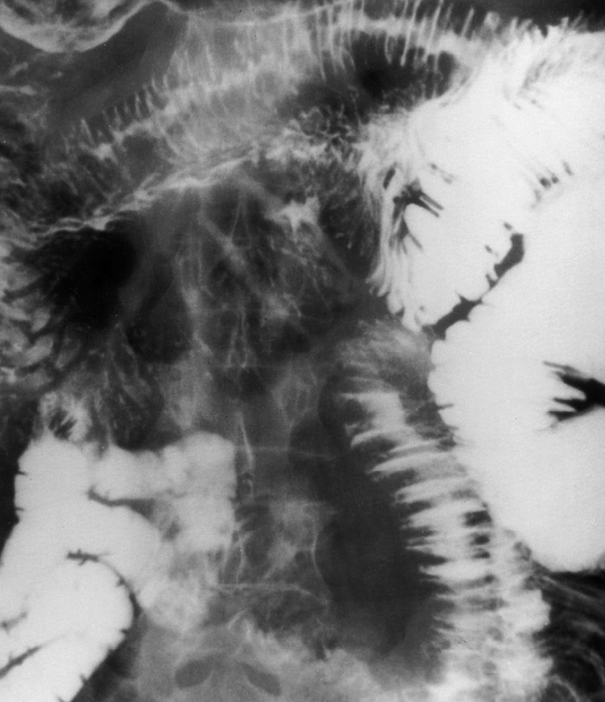 <p><strong>a deficiency in the number of platelets</strong>, and it results in spontaneous hemorrhages in the skin, mucous membranes of the mouth, and internal organs.<span>&nbsp;</span></p>