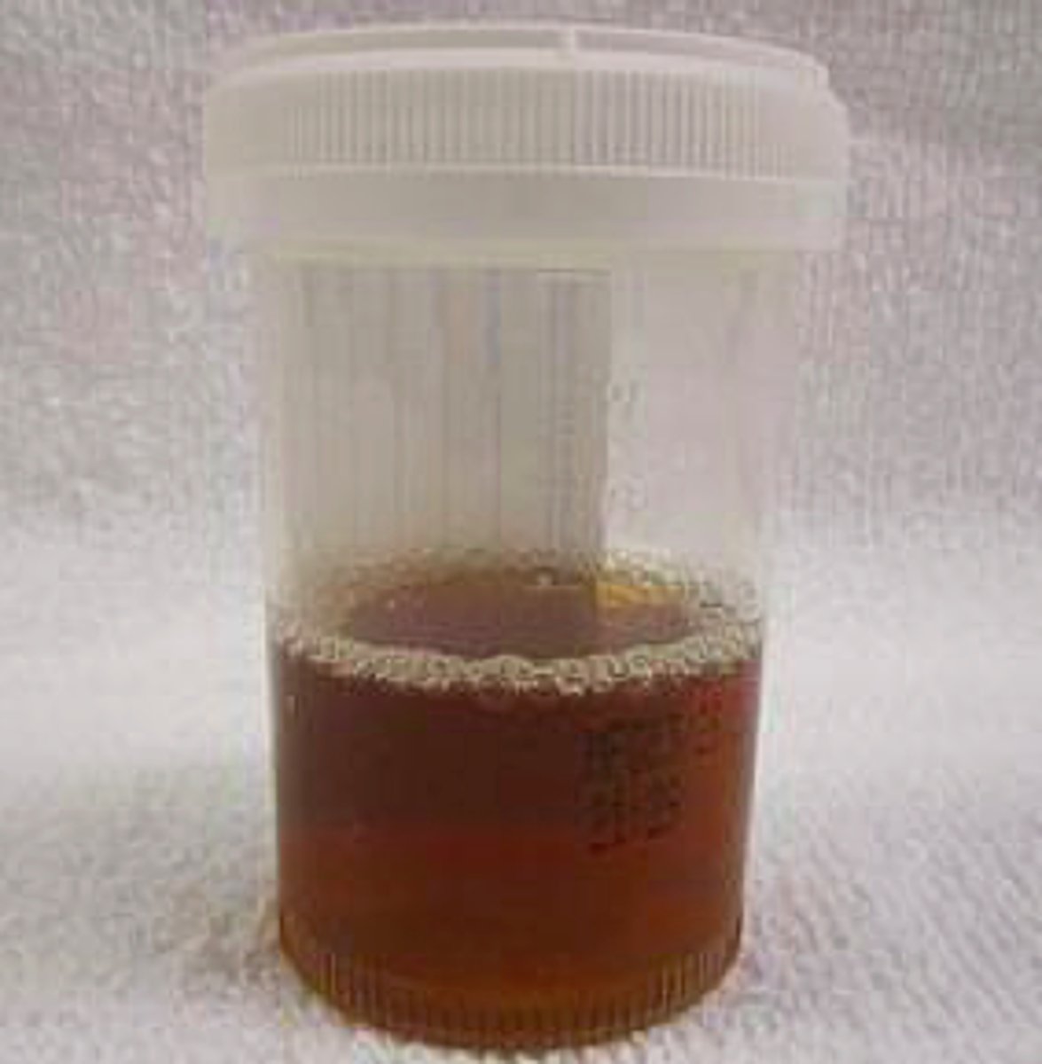 <p>Classic triad</p><p>- Muscle pain</p><p>- Weakness</p><p>- Dark coca cola urine (myoglobinuria)</p>
