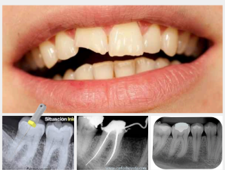 <ul><li><p>Causada por traumatismos dentarios que afecten tanto a la corona como a la raíz del diente. Asimismo, las alteraciones oclusales como bruxismo, sobrecarga oclusal y maloclusiones pueden desencadenar daño periapical.</p></li><li><p>También la patología pulpar en forma de pulpitis y necrosis produce alteración periapical, además de la etiología iatrogénica debido a la sobreinstrumentación o sobreobturación en los tratamientos de conductos radiculares.</p></li><li><p>Esta caracterizada por hiperemia, congestión vascular, edema del ligamento periodontal, extravasación de neutrofilos y monocitos y una reabsorción osea limitada que no es detectada radiograficamente a menos de que un absceso esté involucrado.</p></li><li><p>Cuando se presenta una infección que cause la periodontitis apical aguda, los neutrofilos acaban con los microorganismos y los monocitos junto con macrófagos liberan leucotrienos y prostaglandinas, causando asi la inflamación del periodonto apical y se activan los osteoclastos.</p></li></ul><p></p>