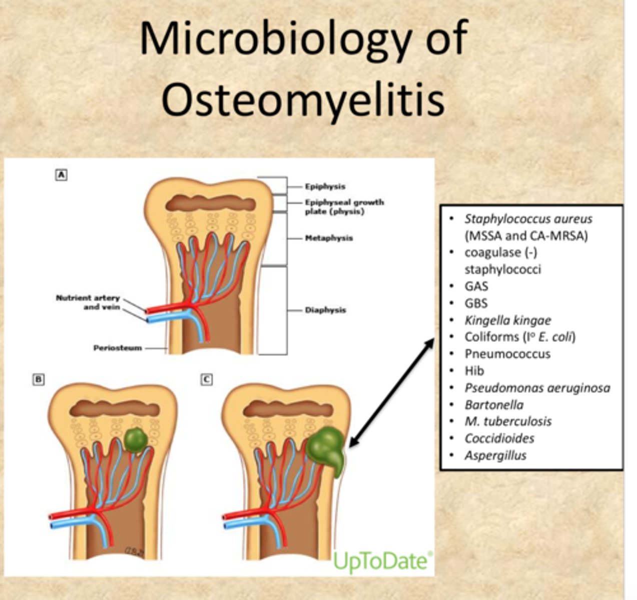 <p>Severe infection of the bone, bone marrow, and surrounding soft tissue</p>