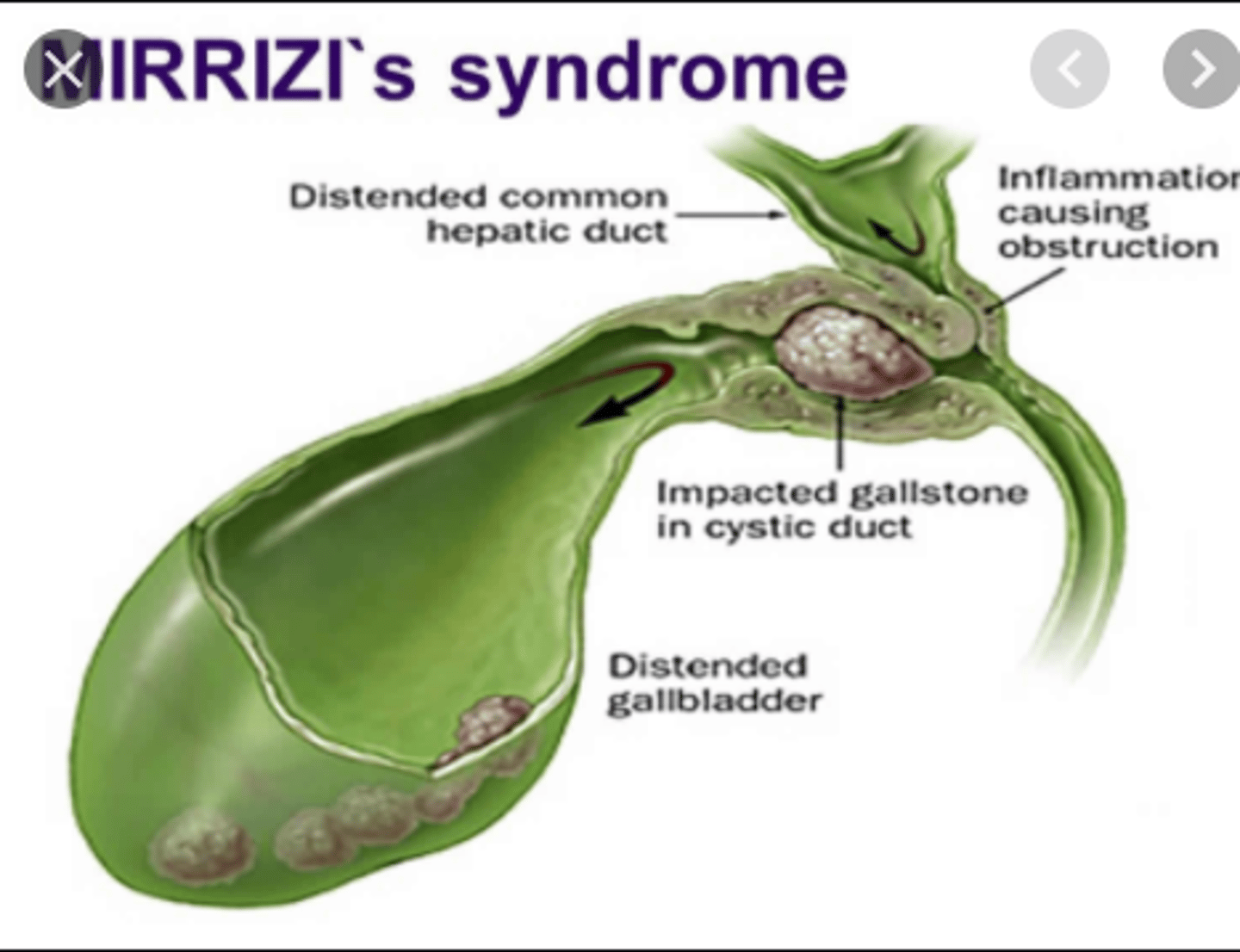 <p>Mirizzi Syndrome</p>