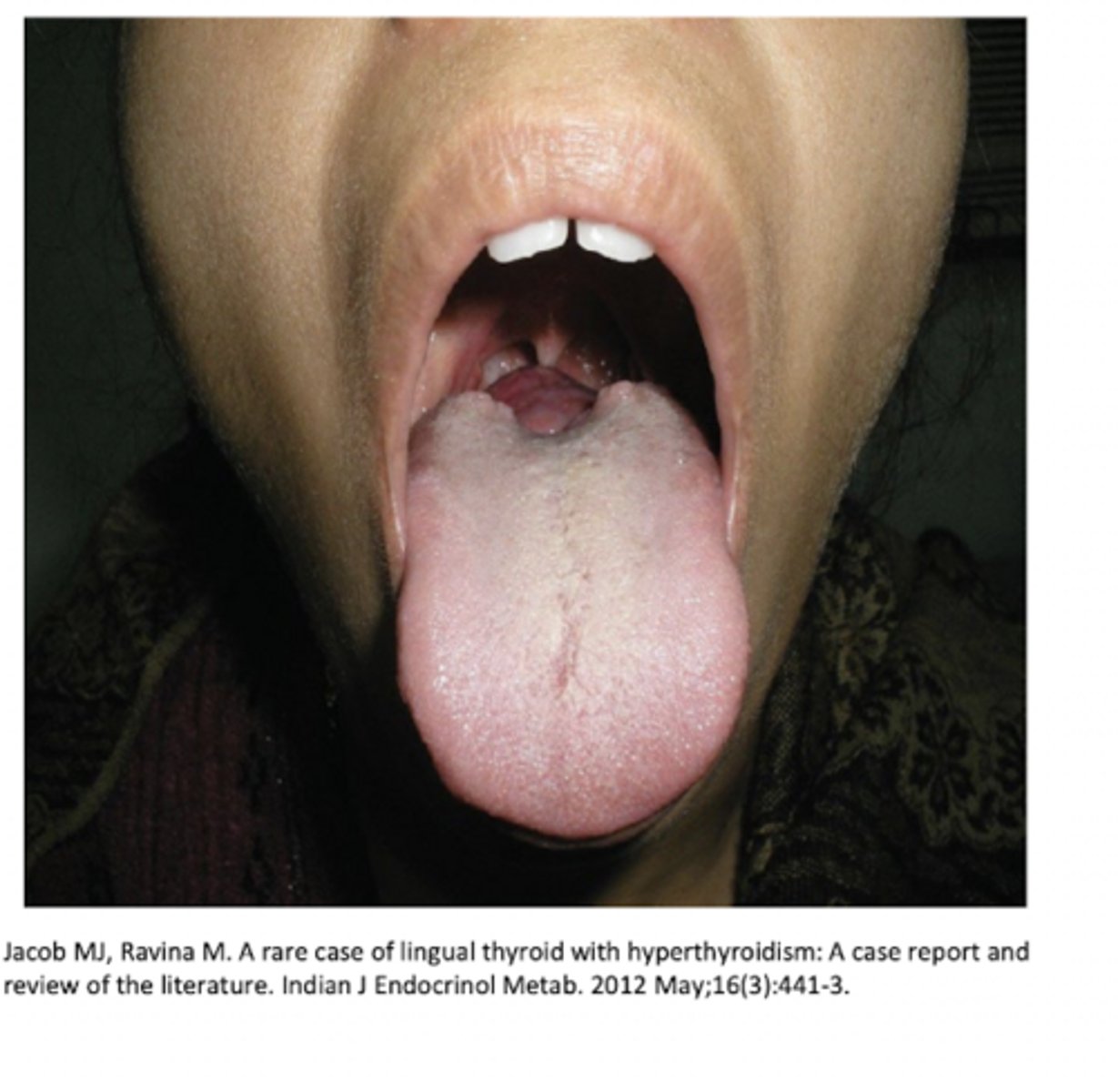 <p>hyoid; tongue</p>