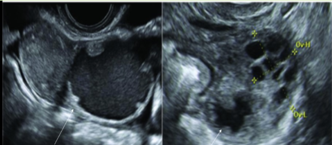 <p>which is a common sono sign of <strong>acute</strong> PID</p><p>a) <5mm wall thickness of fallopian tube</p><p>b) thin walled, anechoic avascular adnexal structure</p><p>c) cogwheel sign</p><p>d) beads on a string sign</p>