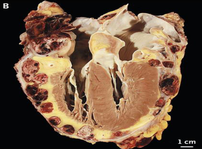 <ul><li><p>malignant cardiac tumor</p></li><li><p>Most common primary malignant tumor</p></li><li><p>Mostly occur in the RA</p></li><li><p>Infiltrates into cardiac tissue</p></li><li><p>Large, mural mass</p><ul><li><p>May extend into the pericardium</p></li></ul></li></ul>