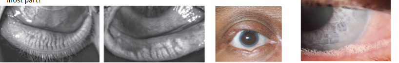 <p>symptoms of posterior blepharitis </p>