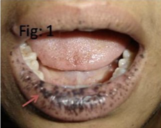 <p>Benign polyps called hamartomas on mucous lining of gastro-intestinal system</p><p>Dark blue to dark brown skin freckling (melanocytic macules) around the mouth, eyes, nostrils, fingers, oral mucosa and anus (perianal)</p><p>Highly increased (up to 93%) risk of developing gastrointestinal and other cancers including breast, cervical, uterine, pancreas, testes, and lung </p><p>Most patients develop cancer by fifth decade</p><p></p>