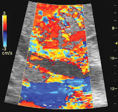 <p>If this image is seen while performing a color doppler exam, the control that should be adjusted:</p><p>a. color gain</p><p>b. volume</p><p>c. 2D gain</p><p>d. color baseline</p>