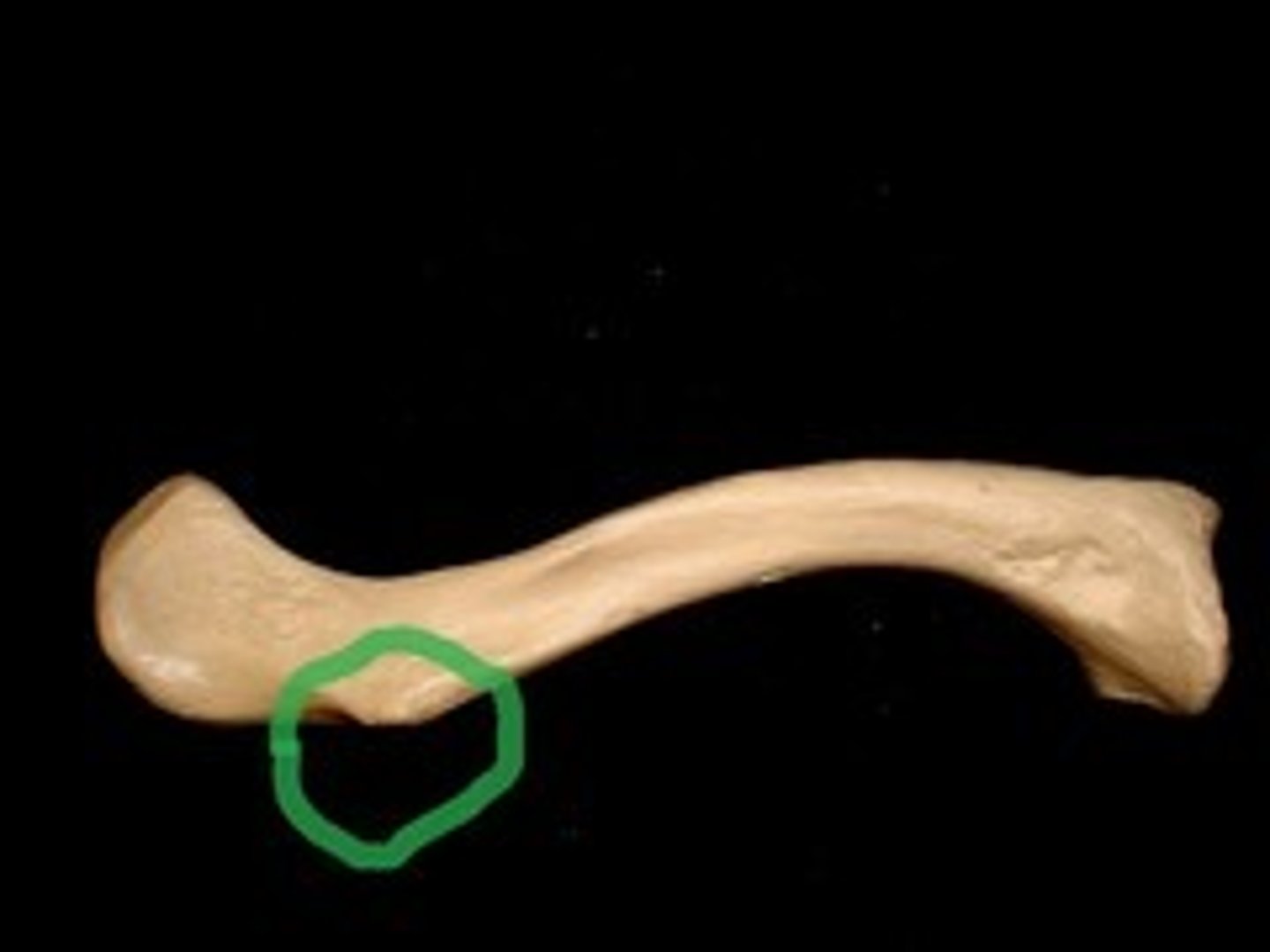<p>on lateral end (acromial extremity) of the CLAVICLE, located posteriorly</p>